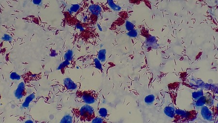 Exame de sangue associado a inteligência artificial abre caminho para diagnóstico precoce da hanseníase